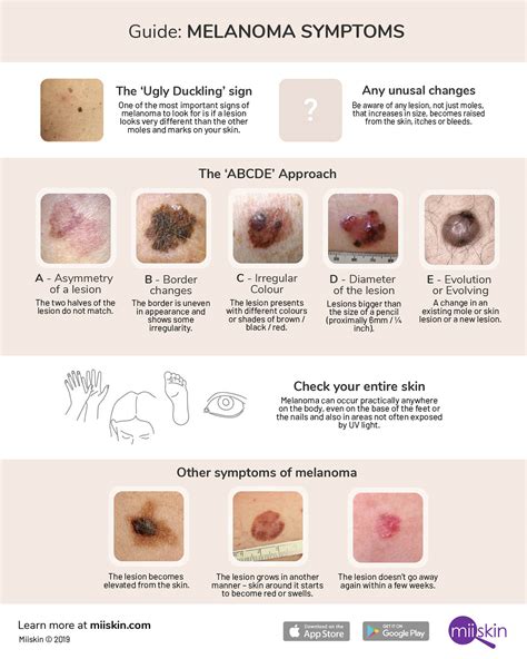 signs of malignant melanoma