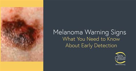 signs of melanoma skin cancer pictures