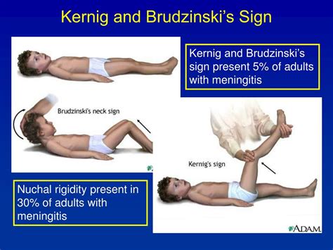 signs of meningitis kernig