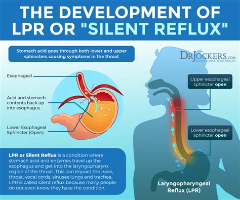 Uncover Hidden Silent Reflux Symptoms for Effective Relief Today