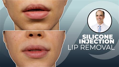 Silicone Lip Injection