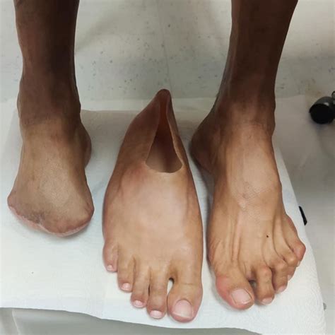silicone partial foot prosthesis cost
