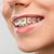 simple braces for teeth
