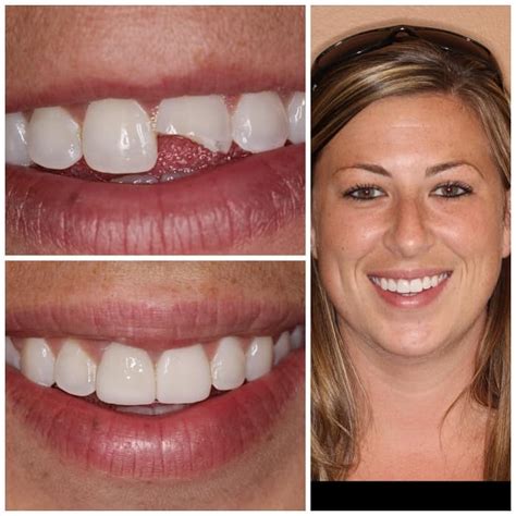 Fishers Smile Gallery McCordsville Dentist Simply Dental
