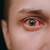 simptom covid mata merah