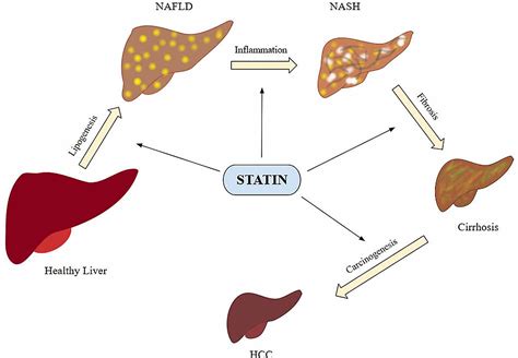 simvastatin and fatty liver