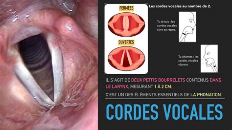 sinechia corde vocali