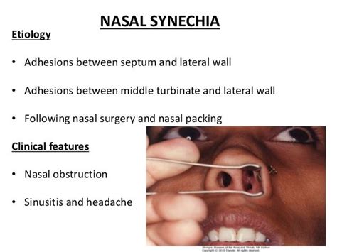 sinechia nasale