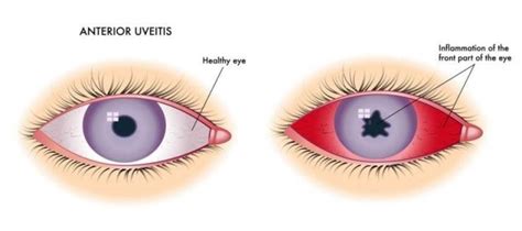 sinechia oculare