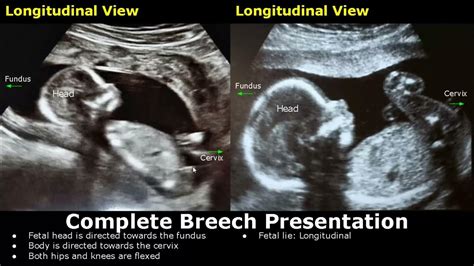 single live fetus in cephalic presentation with good bpp