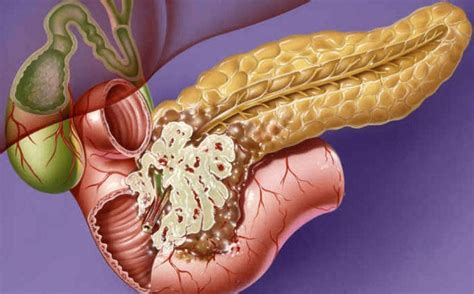 sintomi di tumore al pancreas