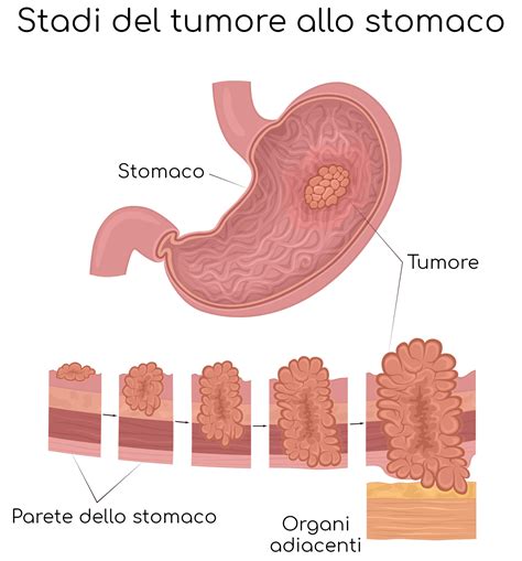 sintomi di un tumore allo stomaco