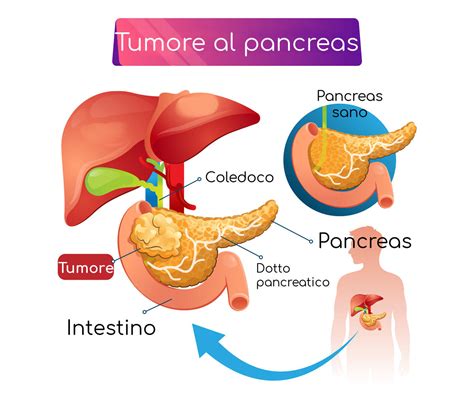 sintomi tumore fegato e pancreas