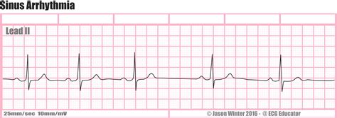 Understanding Sinus Arrhythmia ECG: Causes, Symptoms, and Diagnostic Insights