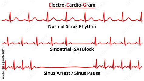 Sinus Block Vs Pause