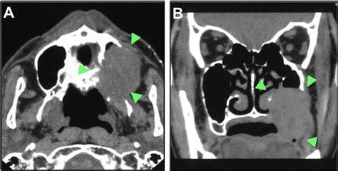 sinus cavity tumor