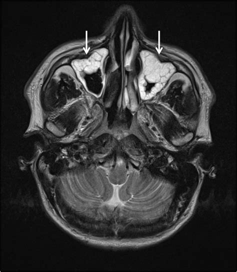 Sinus Disease Mri