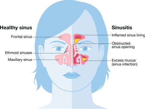 sinus in your chin