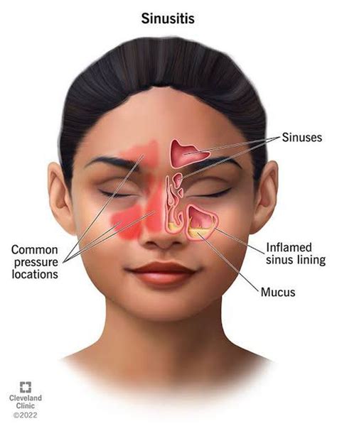 sinus infection to meningitis