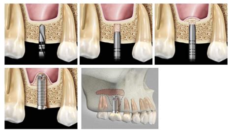 sinus lift and implant