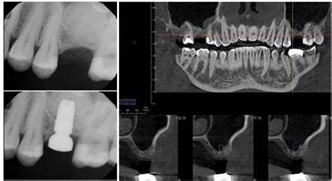 sinus lifting ct