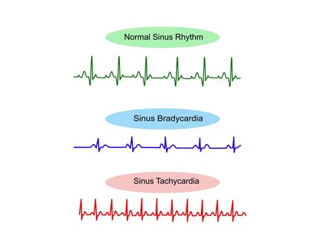 Sinus Rhythm Meaning Explained Simply
