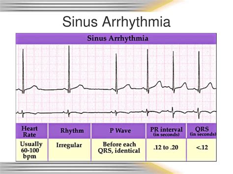 sinus rhythm with marked arrhythmia