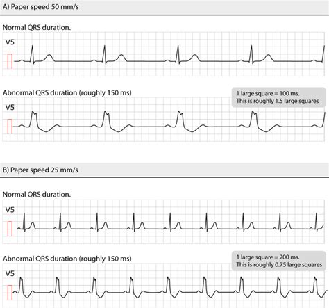 sinus rhythm with wide qrs meaning