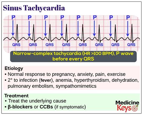 sinus tachycardia definition