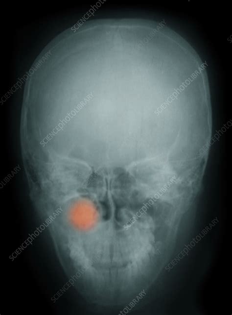 sinus tumour