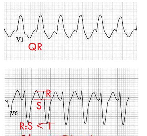 sinus with wide qrs