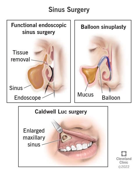 Bouncing Back: What to Expect During Sinuses Surgery Recovery