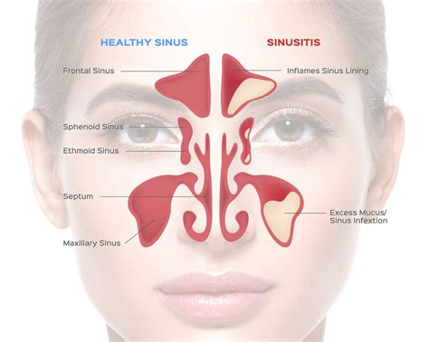 sinusitis