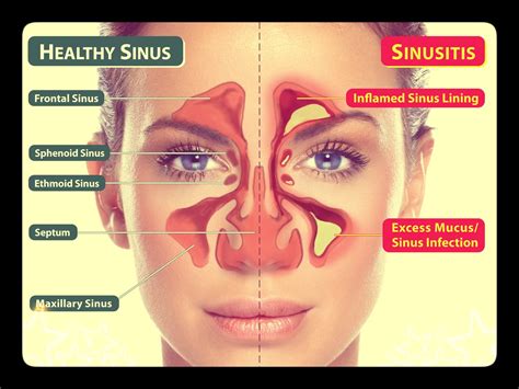 sinusitis and sinus infection