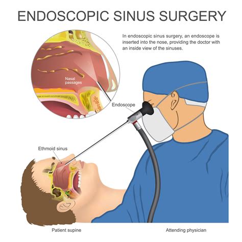 Understanding Sinusitis: What to Expect from a Sinusitis Medical Procedure