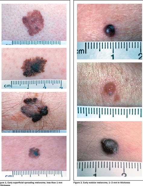 size of nodular melanoma