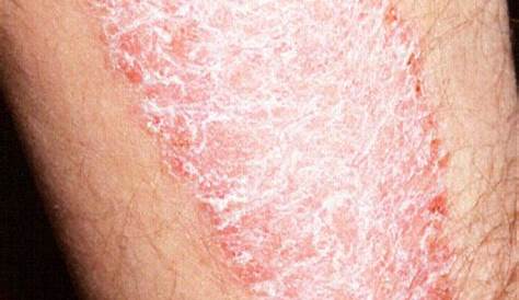 Skin plaque. Causes, symptoms, treatment Skin plaque
