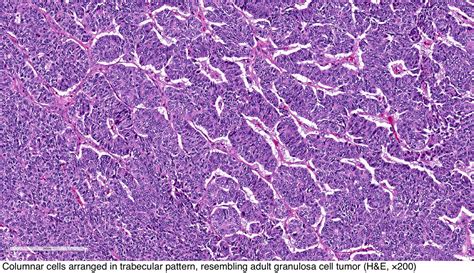 skin adnexal tumor pathology outlines