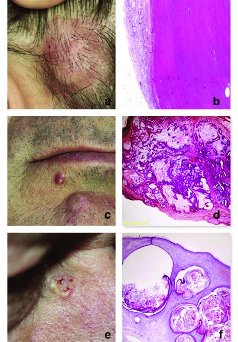 skin adnexal tumors