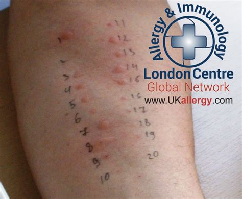 Accurate Skin Allergy Test: Identify Triggers with Confidence Today