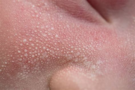 What Causes Small White Skin Bumps and How to Treat Them
