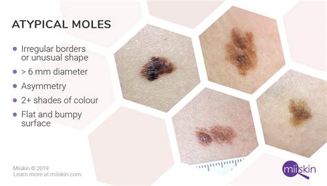 skin cancer atypical mole