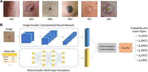 skin cancer detection using deep machine learning techniques