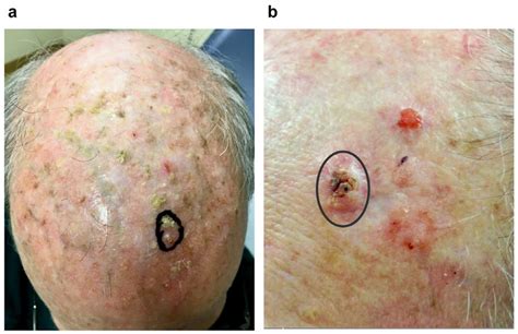 skin cancer of scalp icd 10