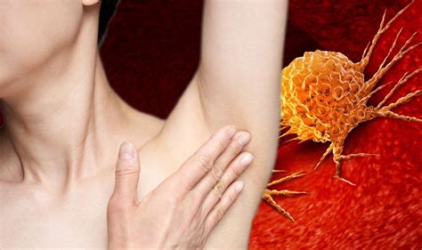 skin cancer under armpit