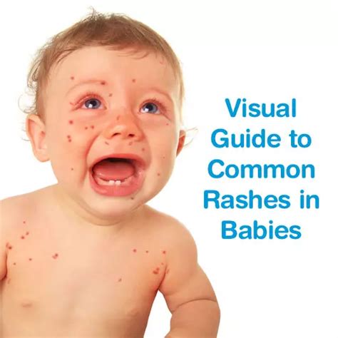 skin irritation in baby rolls