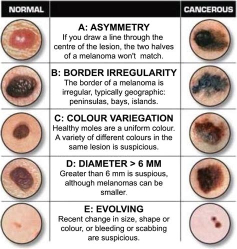 skin lesions that look like melanoma