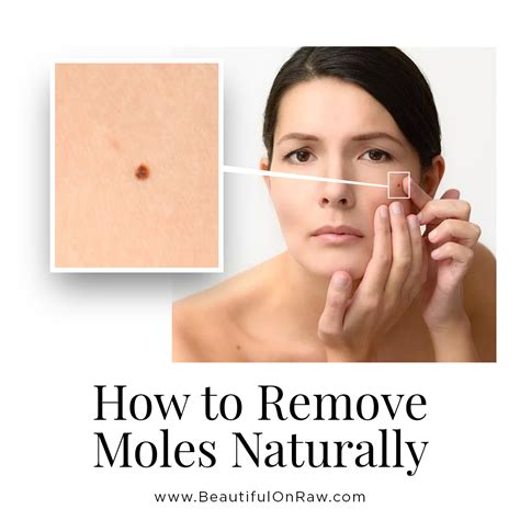 skin mole removal home remedies
