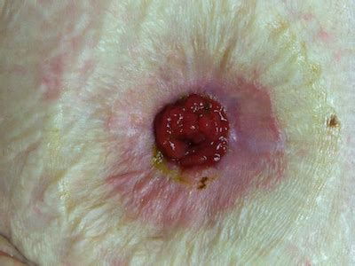 Skin Problems Around Stoma