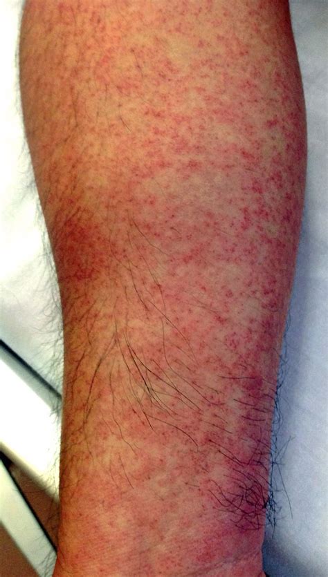 skin rash in dengue fever